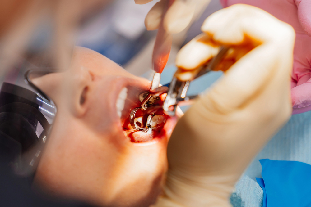 wisdom teeth removal